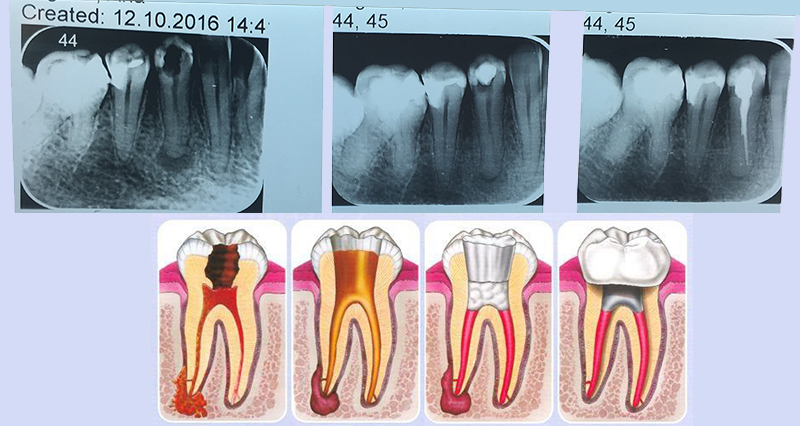 Lečenje periapikalnih procesa na vrhu korena zuba - nehiruško i hiruško